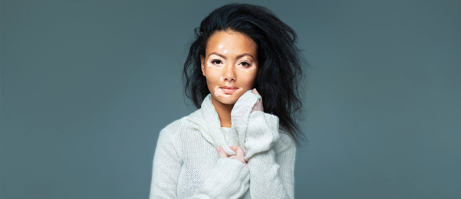 Más allá de la piel: El vitiligo como símbolo de resiliencia